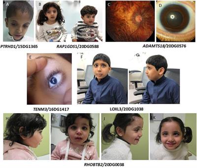 Exploiting the Autozygome to Support Previously Published Mendelian Gene-Disease Associations: An Update